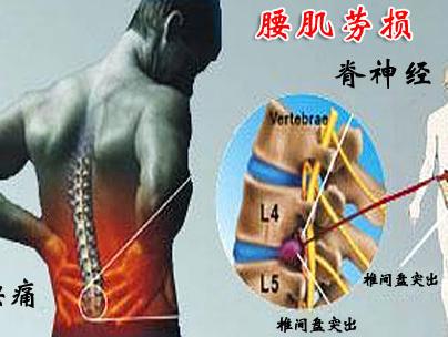 最简单的美白方法-最简单的方法:艾灸调理腰间盘突出!效果好!