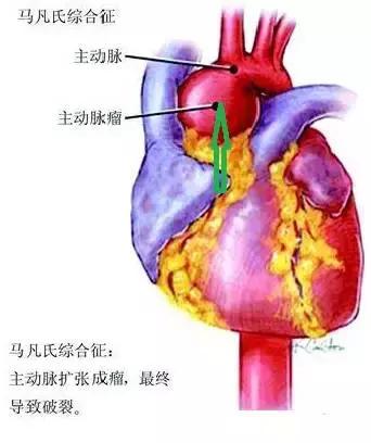 患者升主动脉瘤样扩张,易出现主动脉