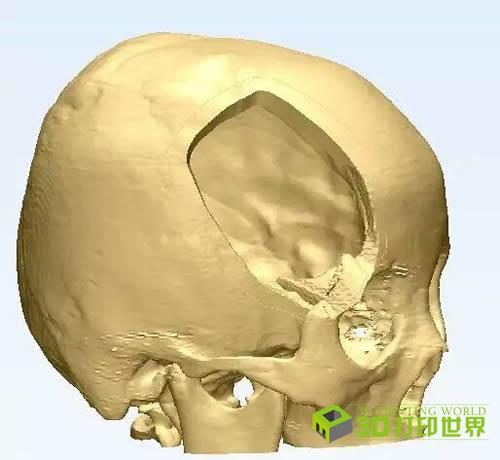 西南医院神经外科教授林江凯介绍,要想彻底切除骨瘤不复发,必须将骨