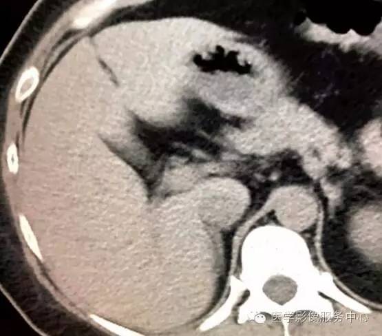一份胸部CT报告,诊断结论附加胆囊结石,没想到
