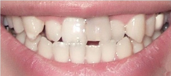 牙齿会影响颜值,更会影响脸型