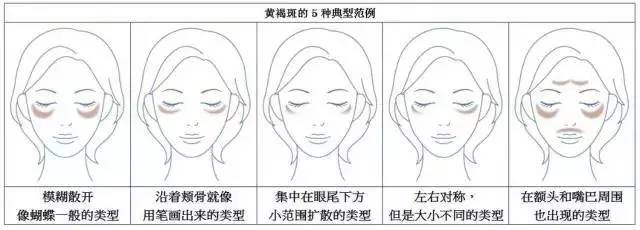 简单祛斑法,帮你赶走斑斑点点