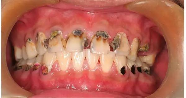 愿望就是医生把洞补起来后一了百了,但是很多情况下龋齿已经危及牙髓