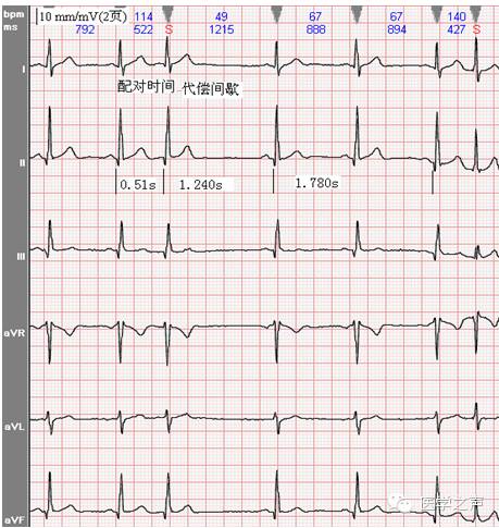 干货| 轻松看懂心电图――房性早搏和交界性早搏