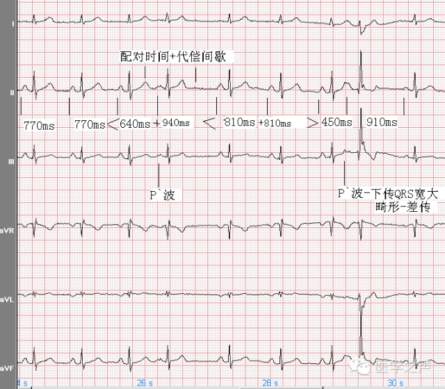 干货| 轻松看懂心电图——房性早搏和交界性早搏