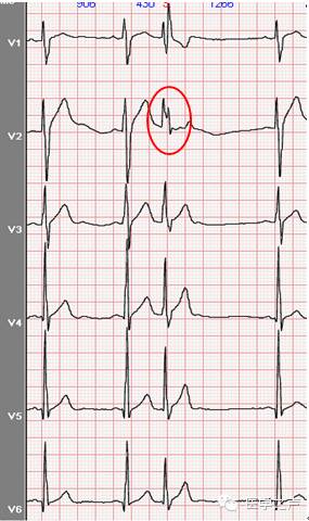 干货| 轻松看懂心电图——房性早搏和交界性早搏