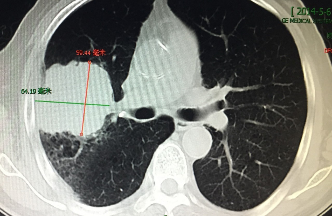 图2. 右肺癌单纯粒子植入术后2个月复查ct示:肿瘤明显缩小.
