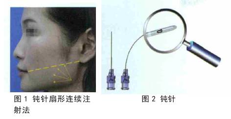 钝针扇形连续注射法在肉毒毒素治疗咬肌肥大中的应用