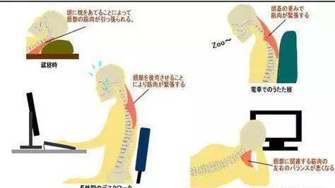 颈椎病是怎样一步步加重,最后导致瘫痪致命的