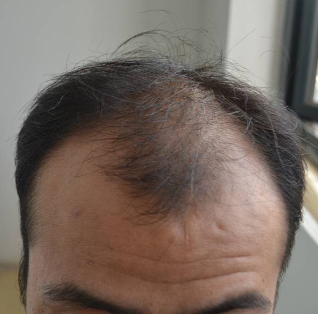 图为(现场拍摄)秦先生自己提供的植发前的照片,头顶快要秃顶了,两边