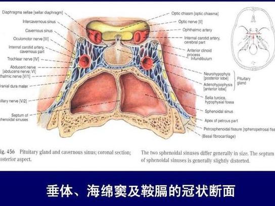 海绵窦海绵状血管瘤的诊疗