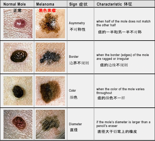 甲床的色素痣叫甲母痣,如果成人发生以下的变化也要提高警惕