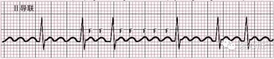 看懂心电图,就这么简单!