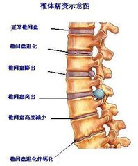 必看,腰间盘突出的最佳治疗方案