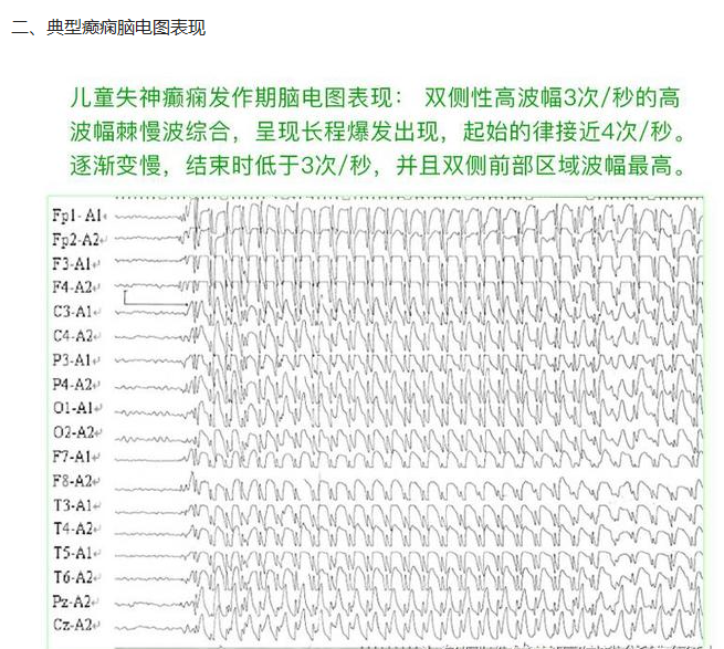 癫痫的脑电图波形表现怎么看