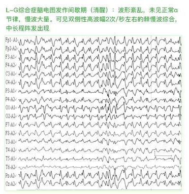 癫痫的脑电图波形表现怎么看