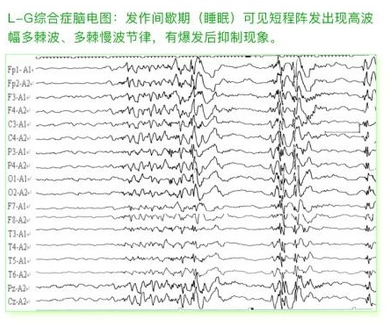 癫痫的脑电图波形表现怎么看