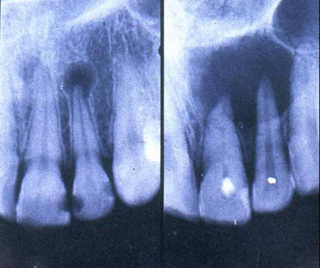 牙槽脓肿脓液排出及中药治疗方法