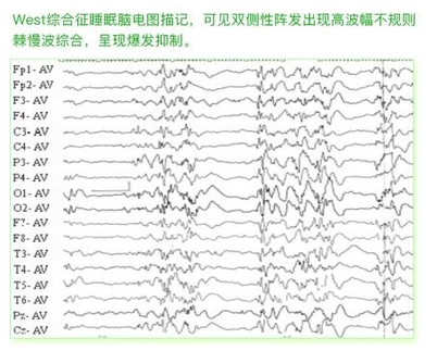 癫痫的脑电图波形表现怎么看