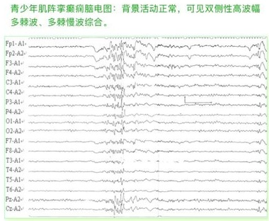 癫痫的脑电图波形表现怎么看