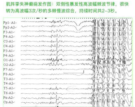 癫痫的脑电图波形表现怎么看