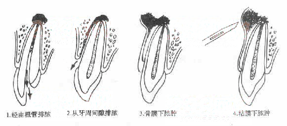 牙槽脓肿脓液排出及中药治疗方法