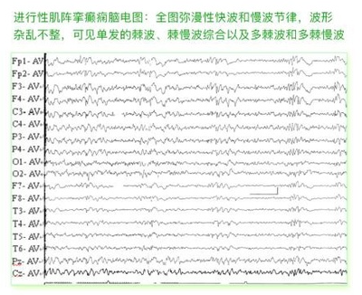 癫痫的脑电图波形表现怎么看