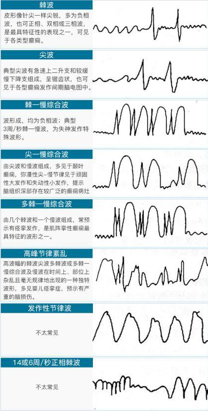 癫痫的脑电图波形表现怎么看