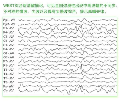 癫痫的脑电图波形表现怎么看