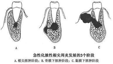 挤出脓液后缩小,过一段时间又增大,反反复复,就是牙根尖脓肿