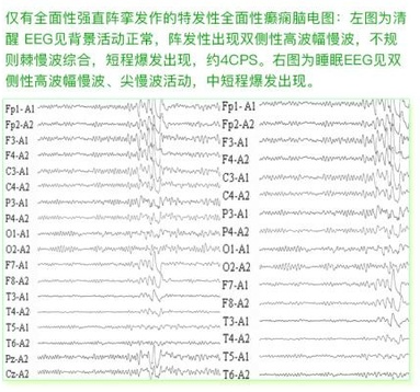 癫痫的脑电图波形表现怎么看