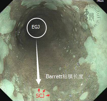 barrett食管背后的故事三形态与分型