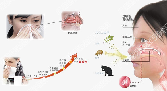鼻喉医院和广州协佳耳鼻喉医院看过敏性鼻炎-