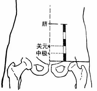 不孕症的治疗可以艾灸关元,神阙,中极,子宫,归来,八髎穴和三阴交.