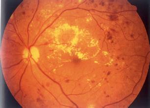 糖尿病眼病 致盲的危险信号