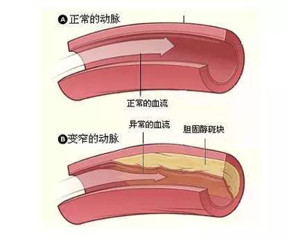 6,发现"动脉斑块"