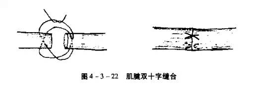 3,细小,扁平的肌腱可作单纯侧壁间断缝合.