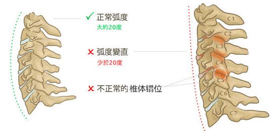 自我颈椎整骨复位--鸡吃米