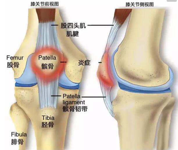 人体42过劳损源于膝关节跑步膝该重视了