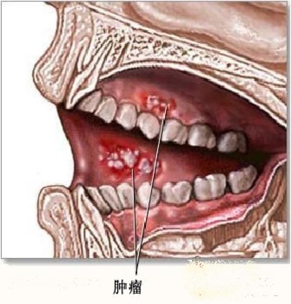 会使口腔黏膜病变致使纤维化,然后致使口腔癌