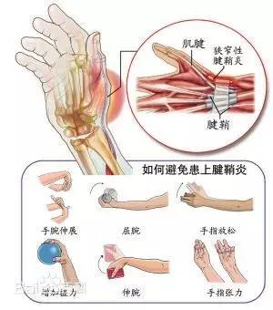 【运动防护】手指腱鞘炎,别让妈妈的手太疼了