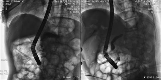 狭窄和(或)囊肿及总胆管胰腺部狭窄等,ercp对慢性胰腺炎的诊断,特别是