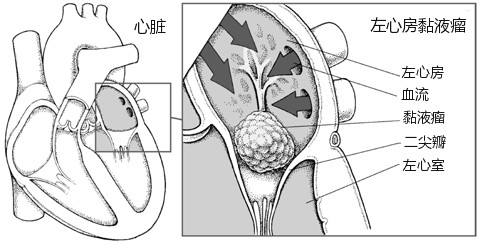 心脏黏液瘤