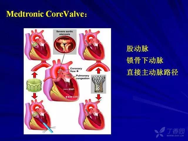 精彩幻灯:经导管主动脉瓣置入术治疗现状