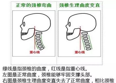 颈椎生理弯曲度变直颈椎生理曲度稍变直
