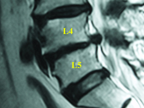 腰椎间盘L4-5节突出采取哪种方式治疗最好?