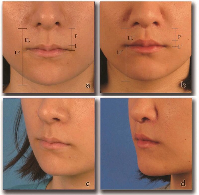 上唇年轻化的探讨上唇人中短缩术84例经验总结