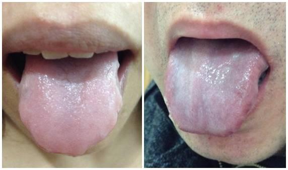 3 阳虚质舌苔症状:舌色淡,舌体胖大,嫩边有齿痕,舌苔润 点评:这种舌苔