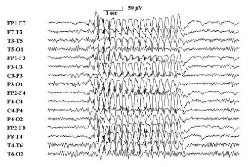 一般患者根据其发作情况癫痫专病医生会制定适当的脑电图检查计划.