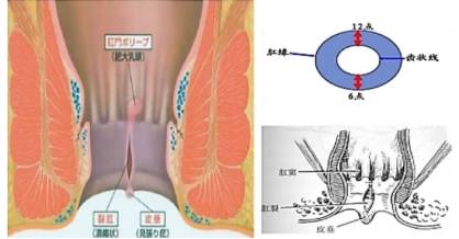 肛门疼痛,警惕肛裂